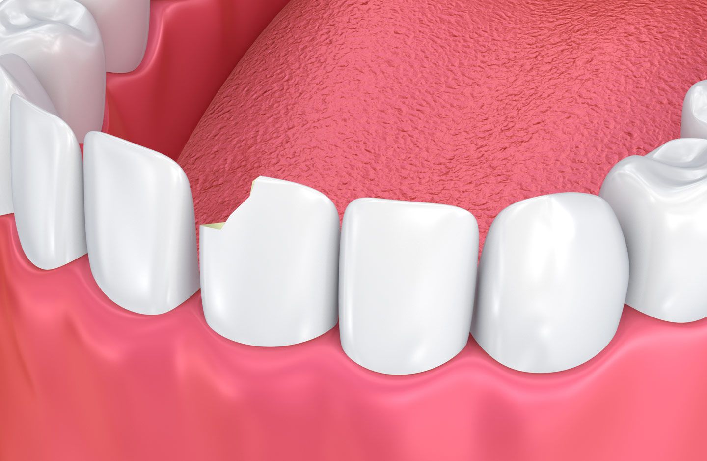 Chipped Tooth Repair - Nashville, TN - Gulch Dental Studio