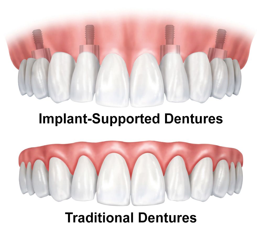 Dentures Virginia Beach, VA Dr. Scott Parr Implant Dentures