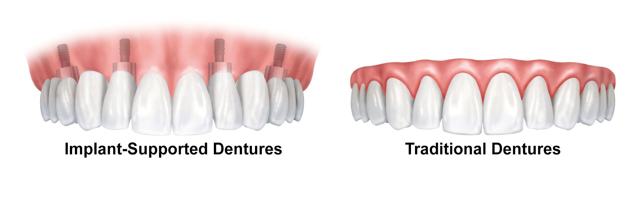 Temporary Dentures vs. Permanent Dentures - Pickett Family Dental