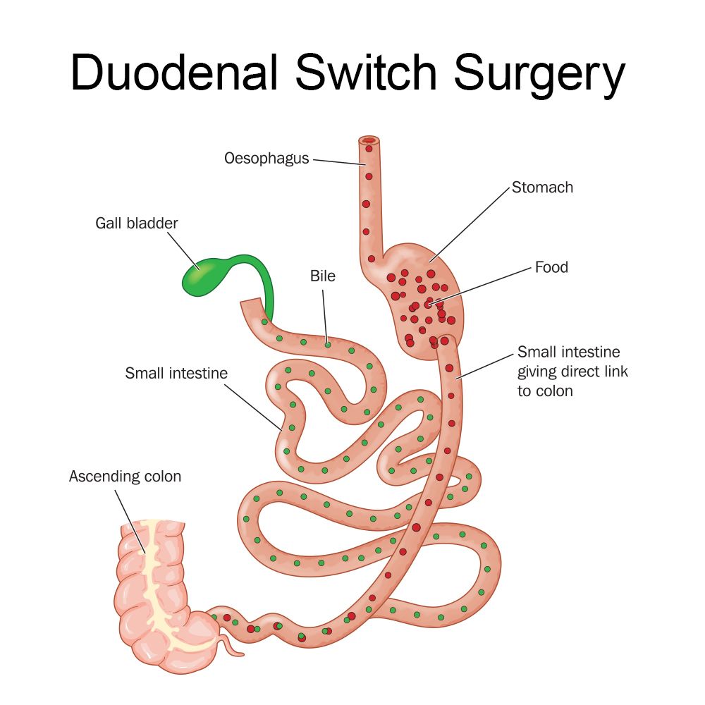 Gastric Bypass Surgery Revision - Tijuana, Mexico Resizing Stomach Pouch