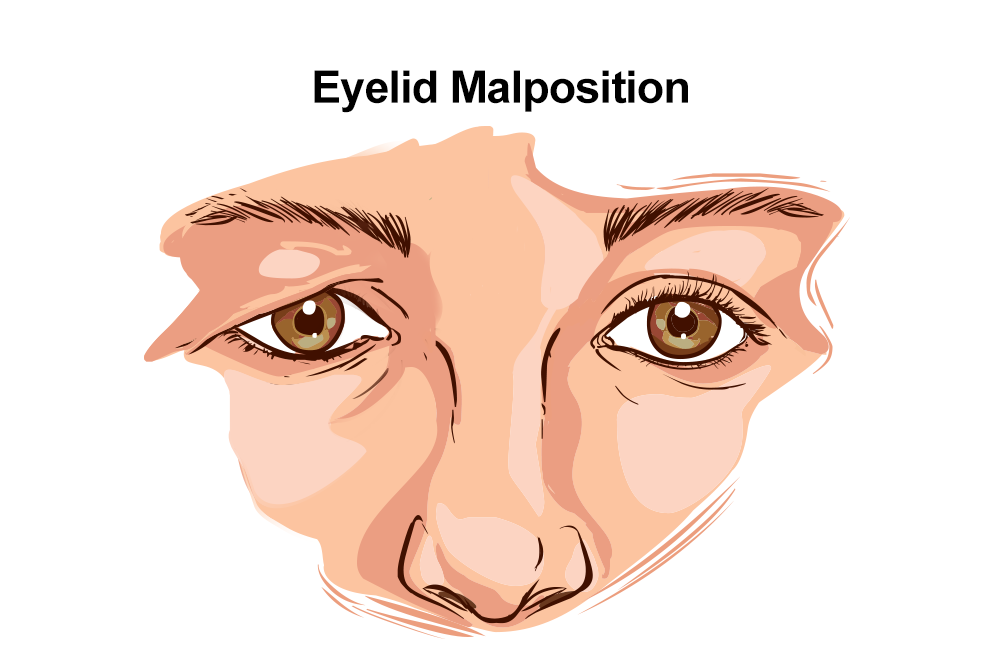 Image of eyelid malposition