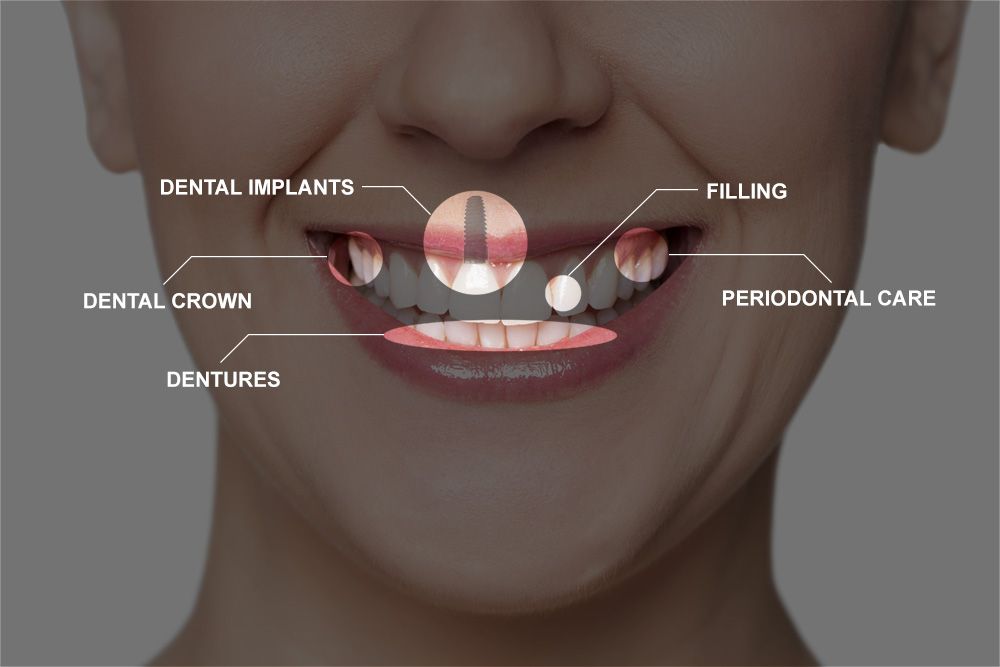 full mouth extraction