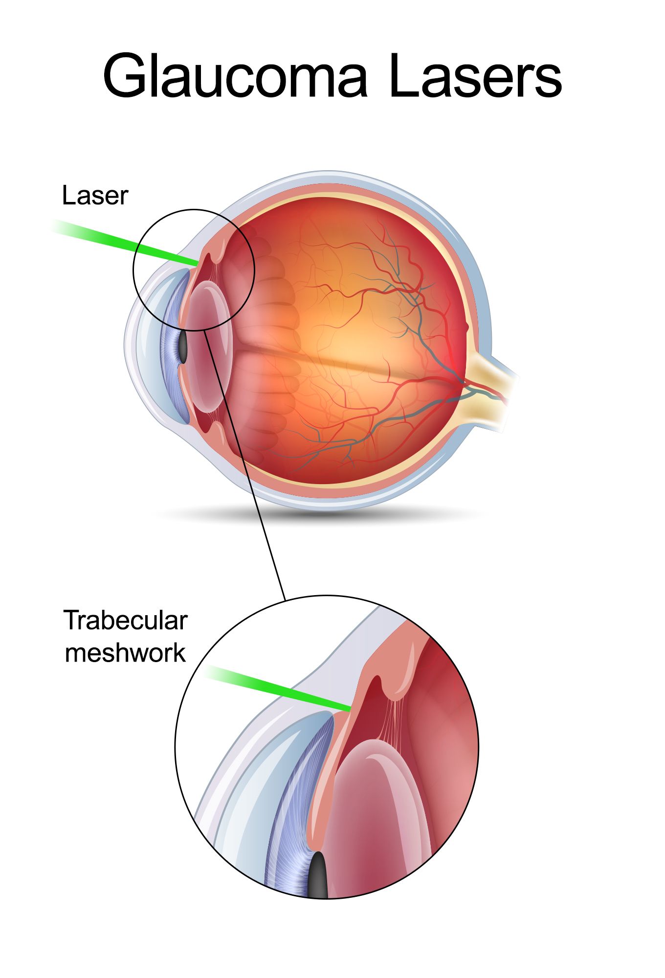 What Is Slt Laser Procedure