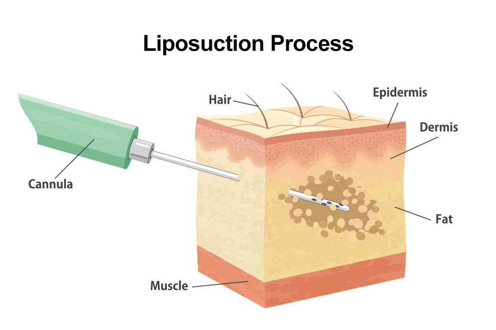 Liposuction Procedure Steps  American Society of Plastic Surgeons