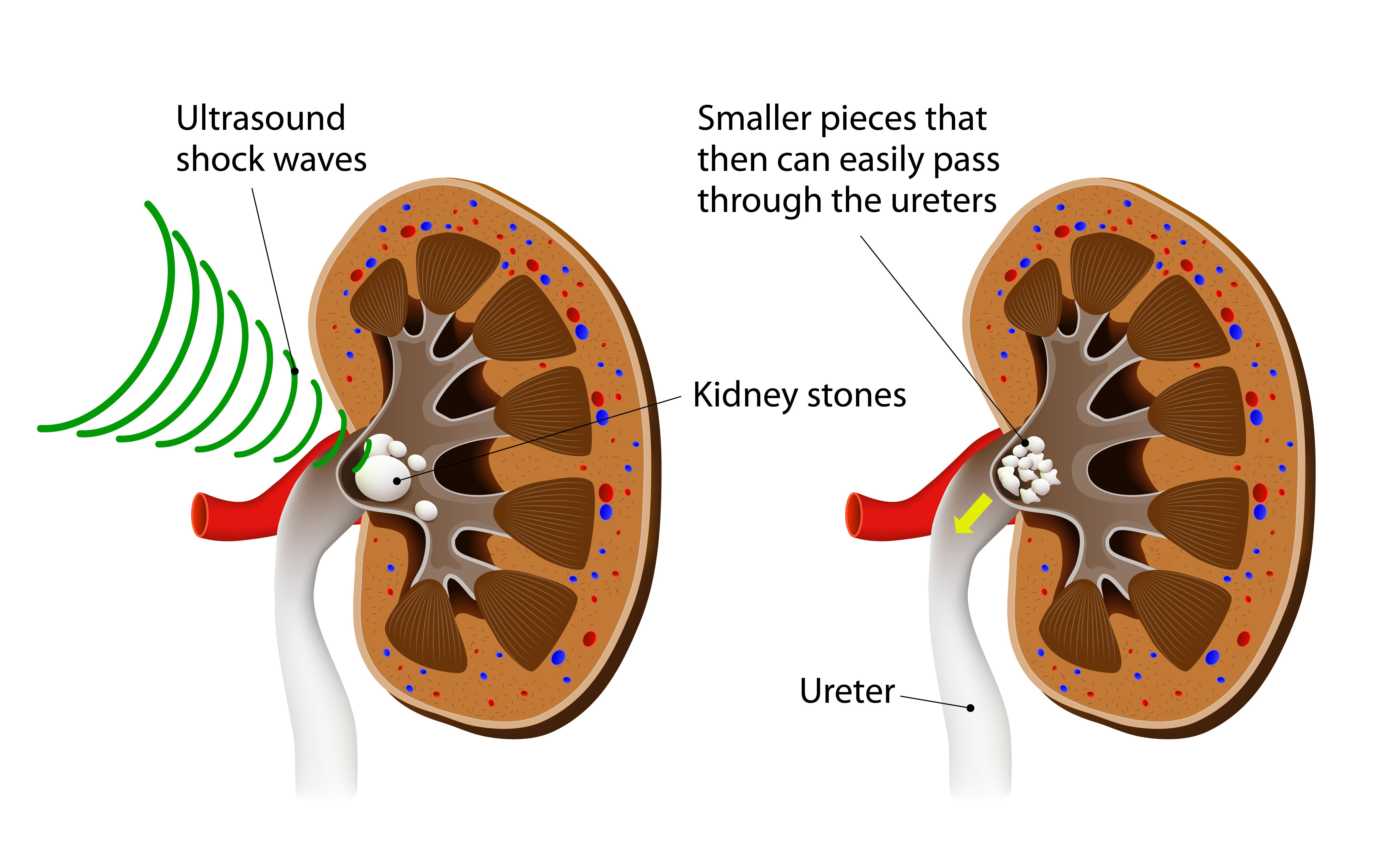 Kidney Stone Treatment – Phoenix, AZ – Dr. Mark Hong