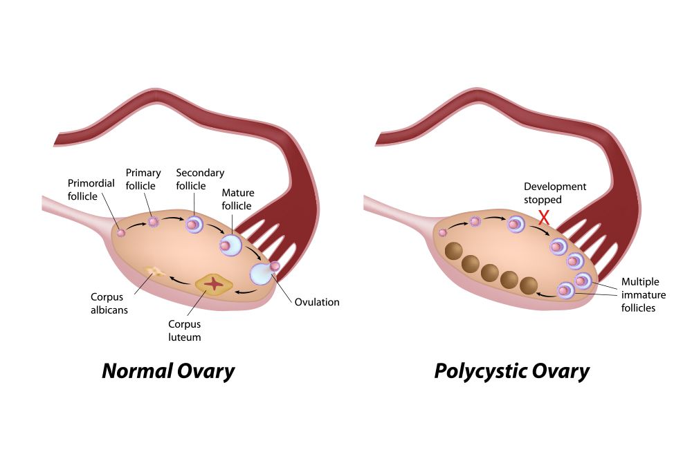 Pcos Symptoms Fort Worth Tx Bedford Tx