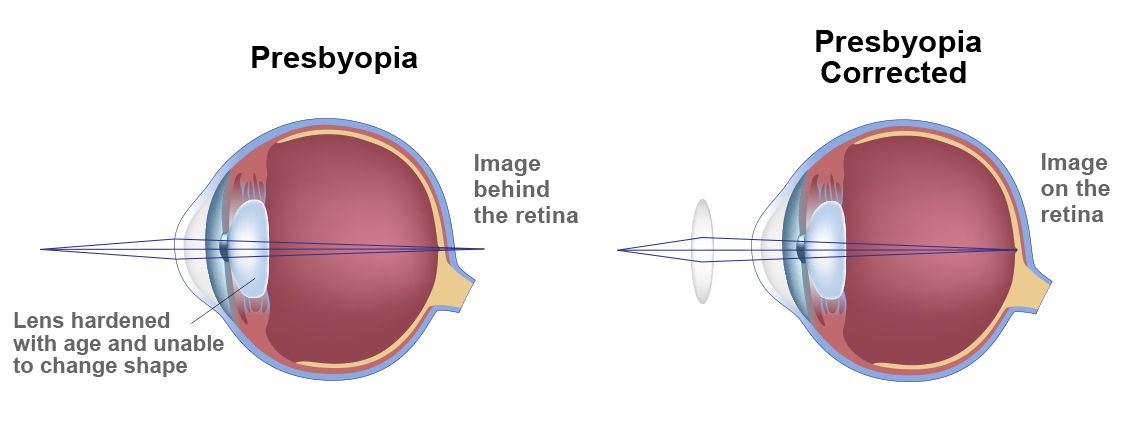 az életkorral összefüggő hyperopia vagy presbyopia