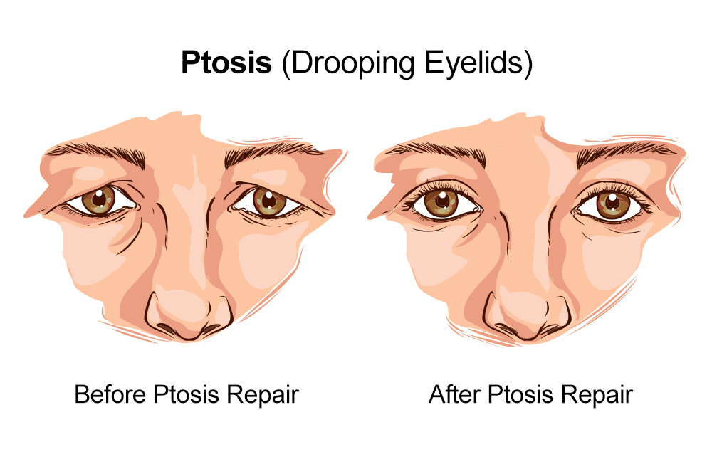 Image of ptosis