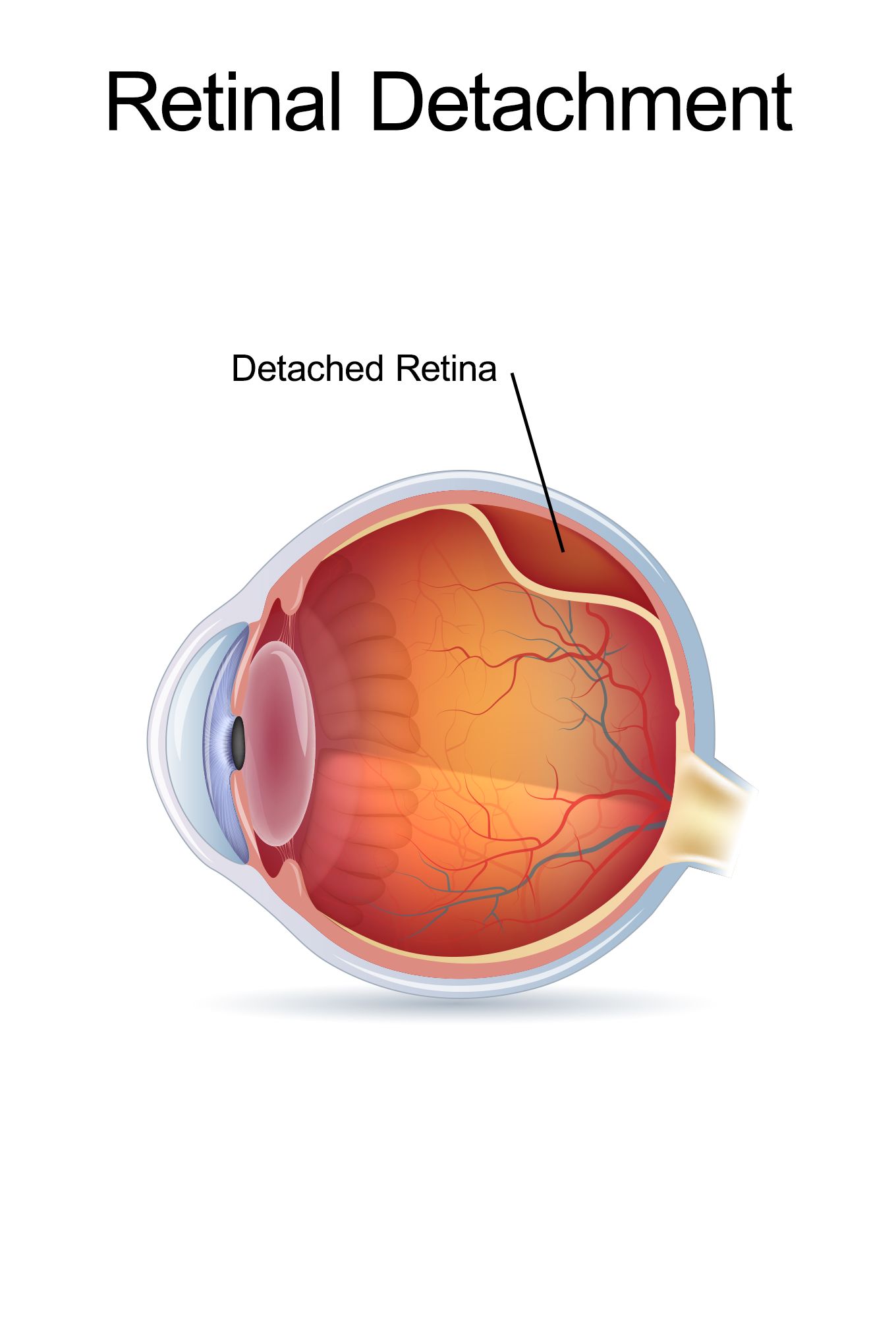 retina detachment surgery recovering