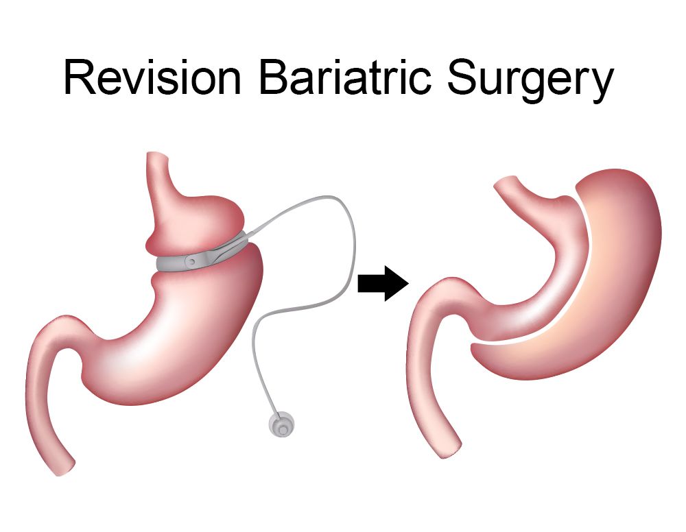 illustration of two stomachs showing revision bariatric surgery
