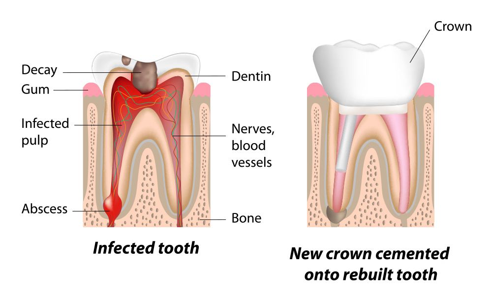 A cross-section of an infected tooth next to a cross-section of a tooth with a dental crown