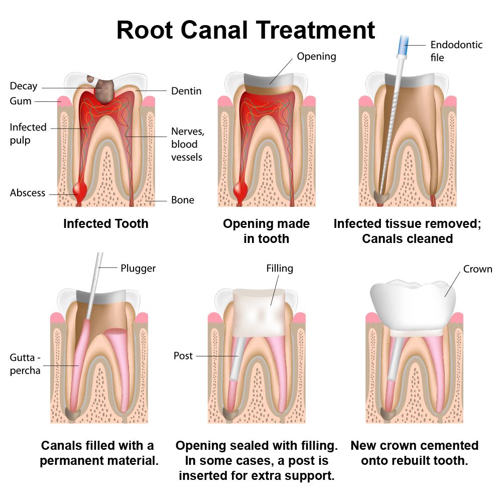 Root Canal Therapy Recovery Edmonton Ab