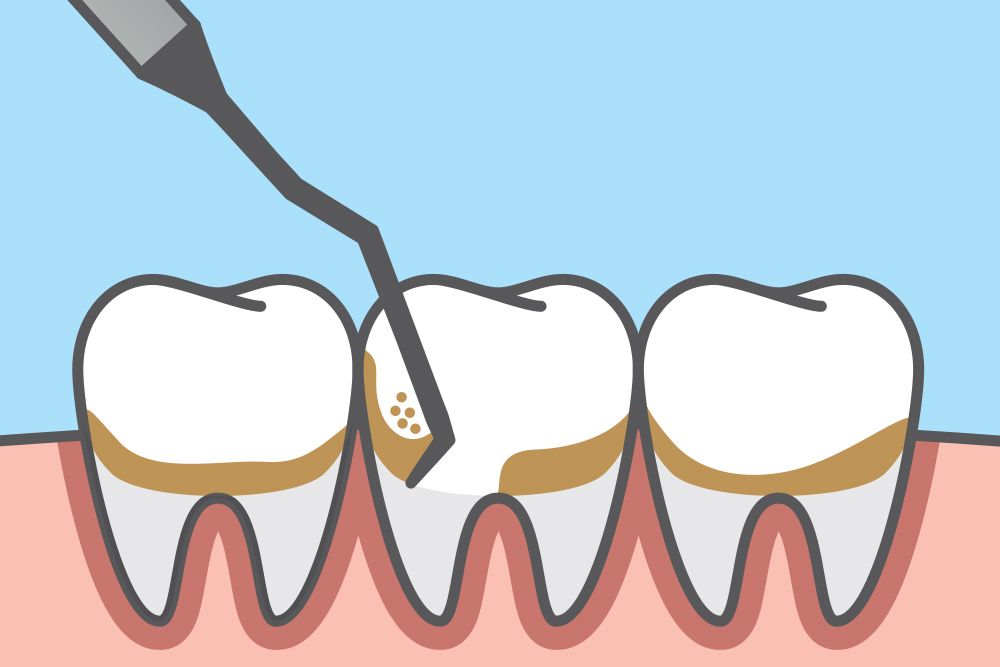 scaling root planing before and stains