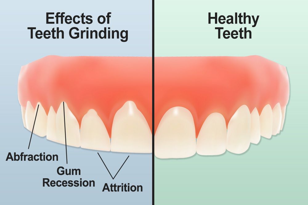 Teeth grinding