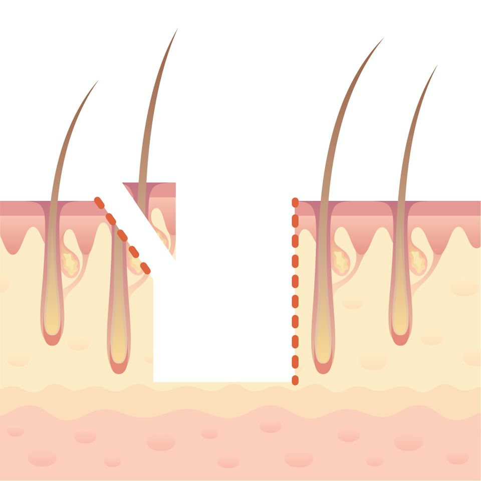 Trichophytic Closure
