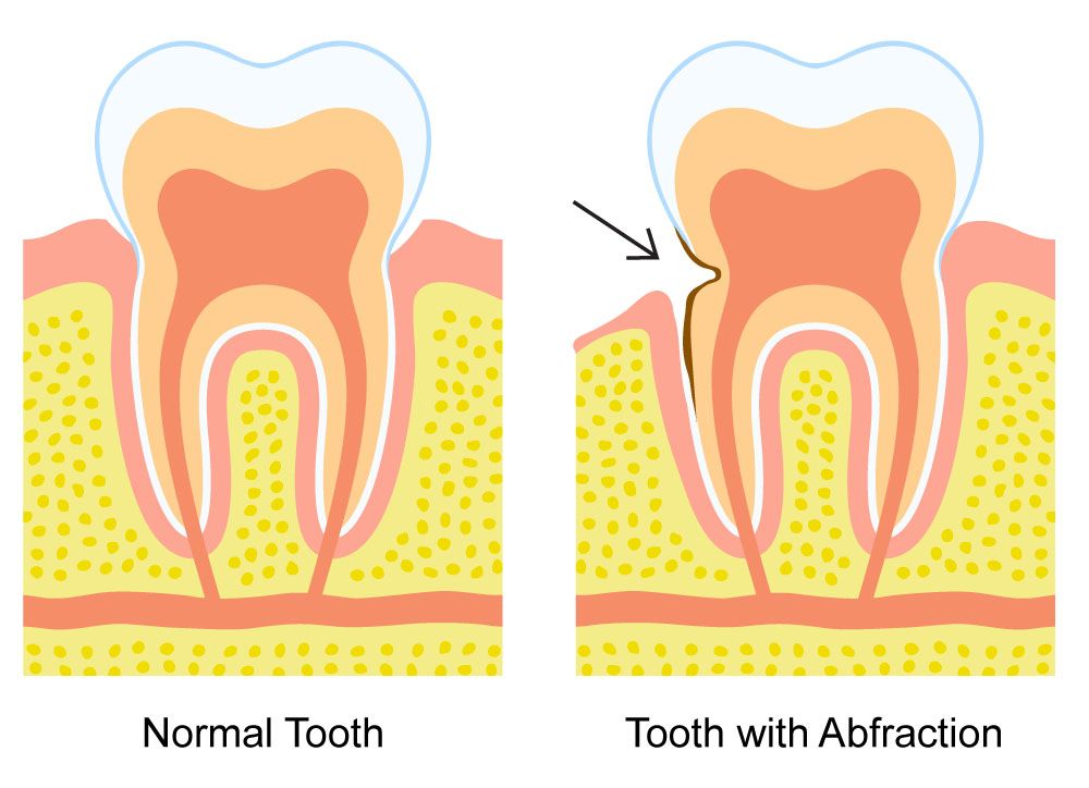 digital illustration comparing normal tooth to tooth with abfraction