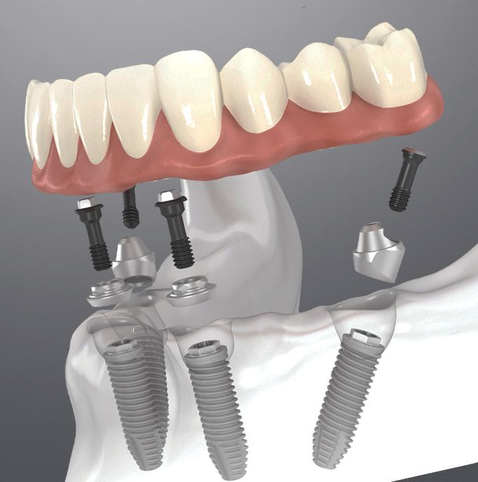 All-on-4 dental implants