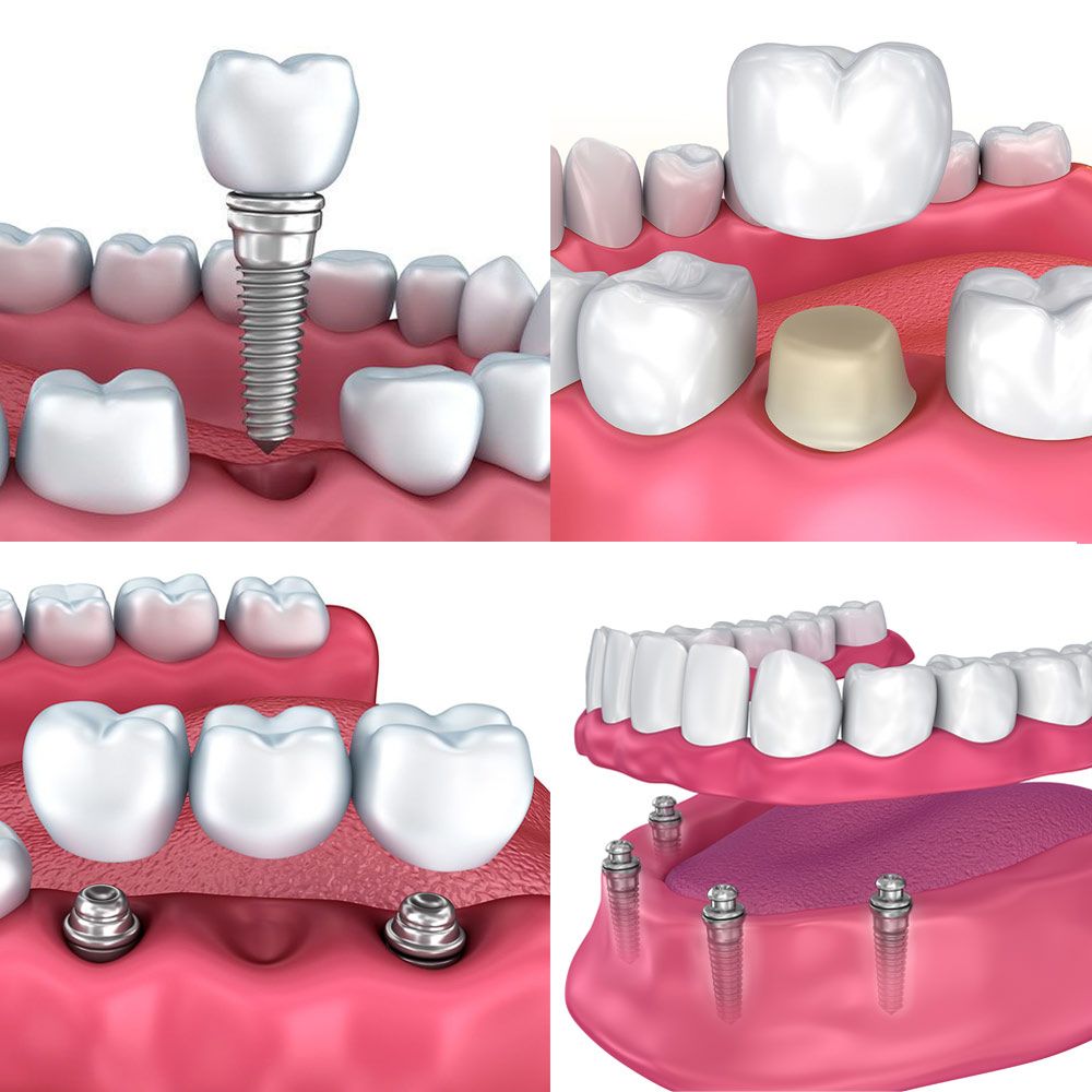 How To Restore Dental Implants