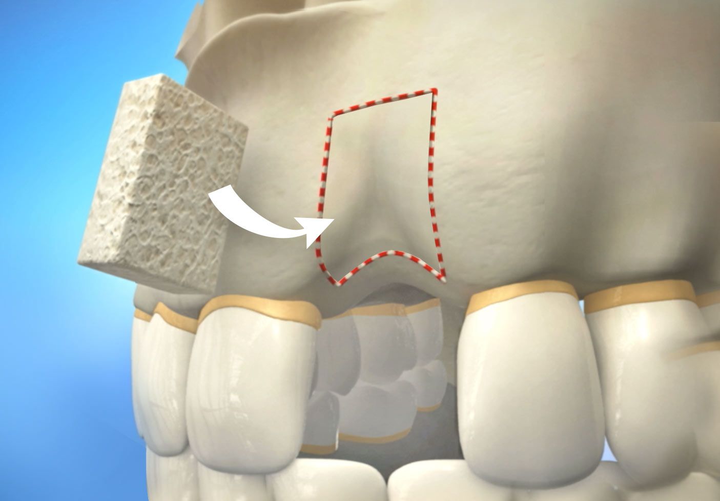 bone grafting