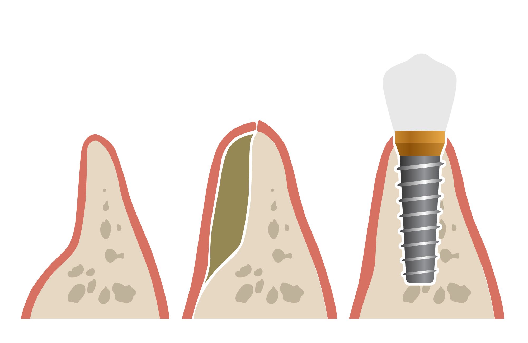 reinserting a knocked out tooth clipart