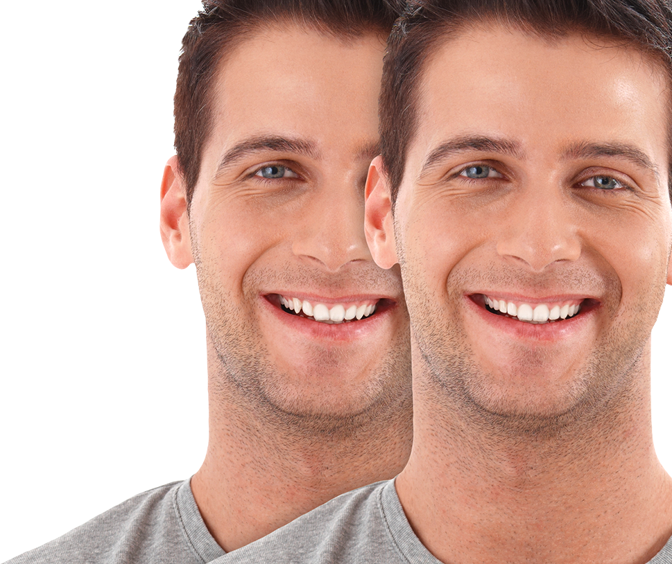 Smiling man before and after crooked teeth