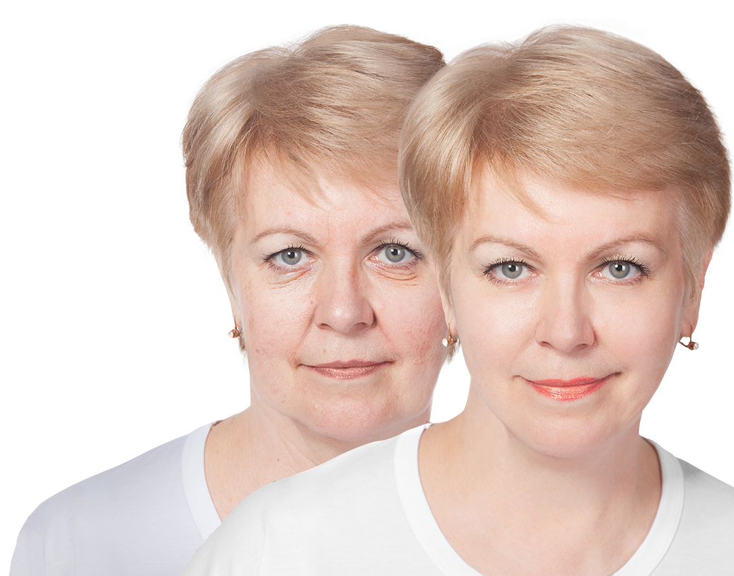 Facelift In Orlando — HZ Plastic Surgery