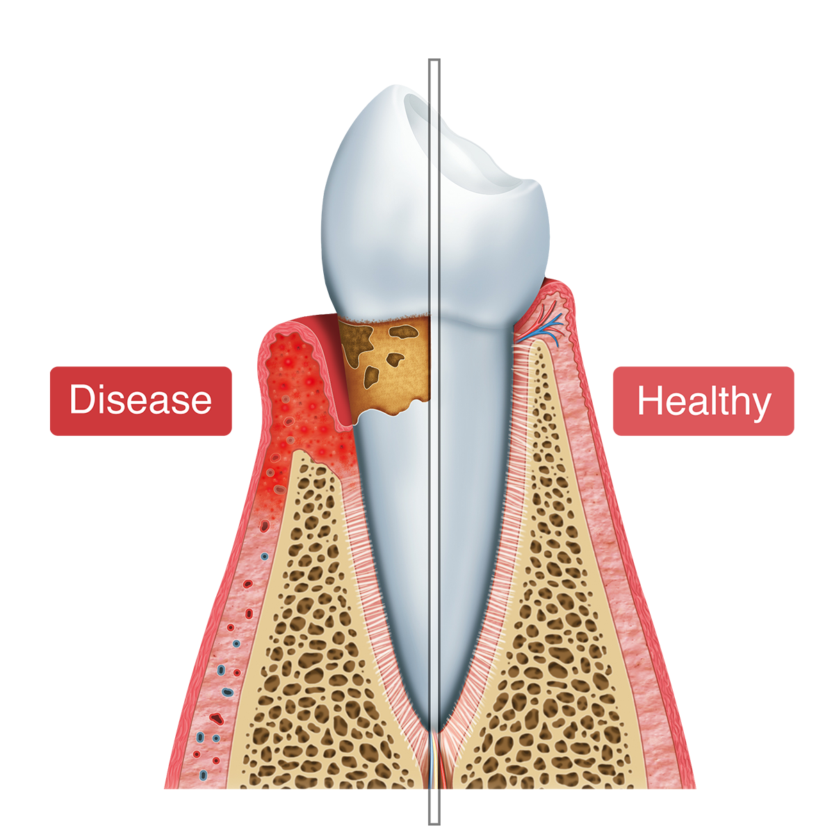 Gum Disease Symptoms Harrisonburg, VA Staunton, VA