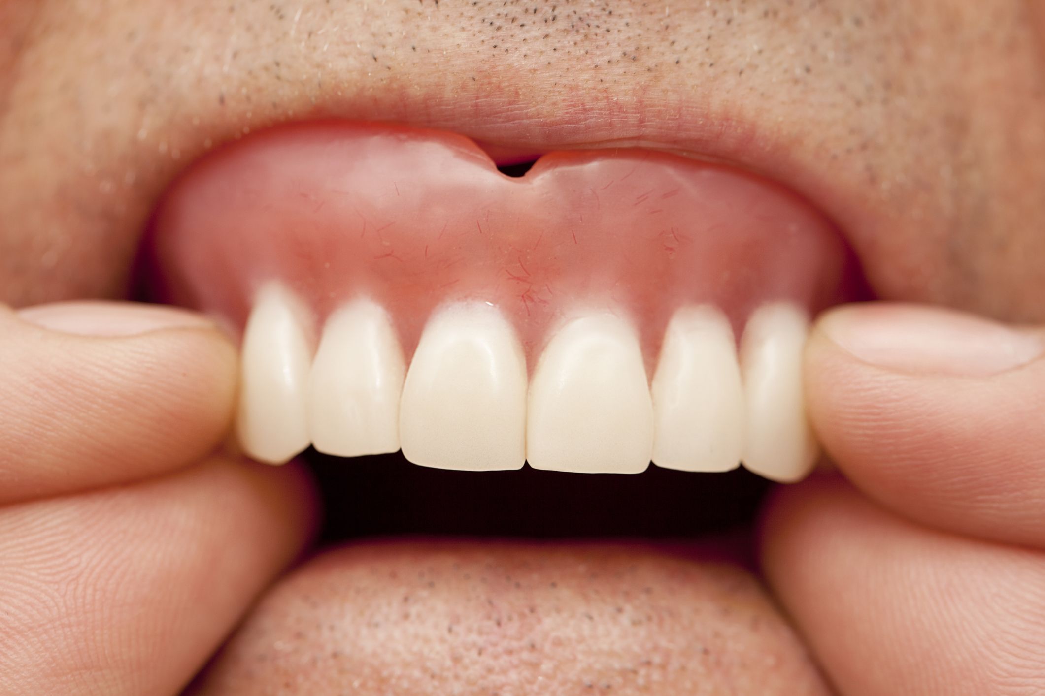 The long-term problems with ill-fitting dentures