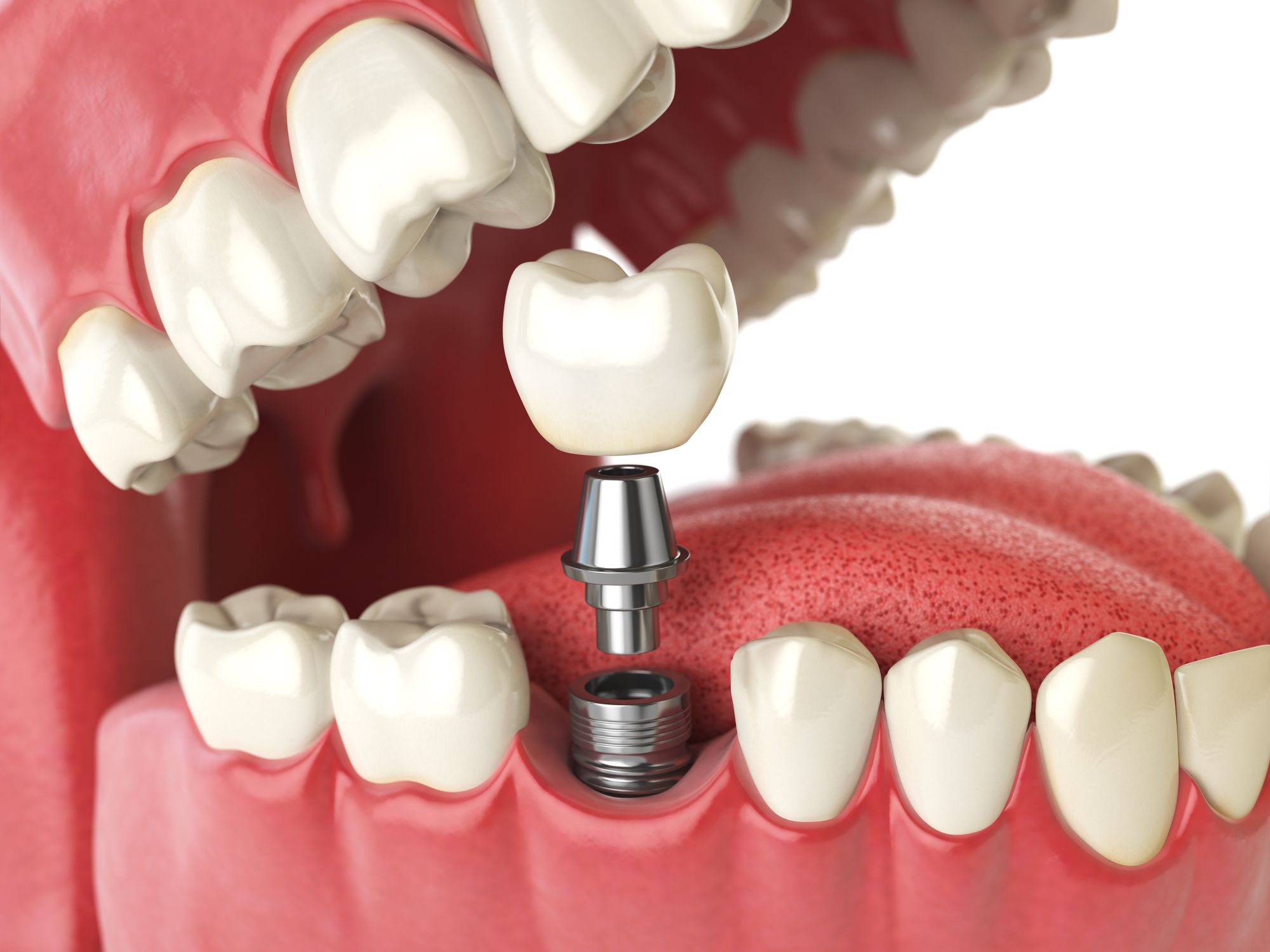 Digital image of dental implant, abutment, and crown being placed