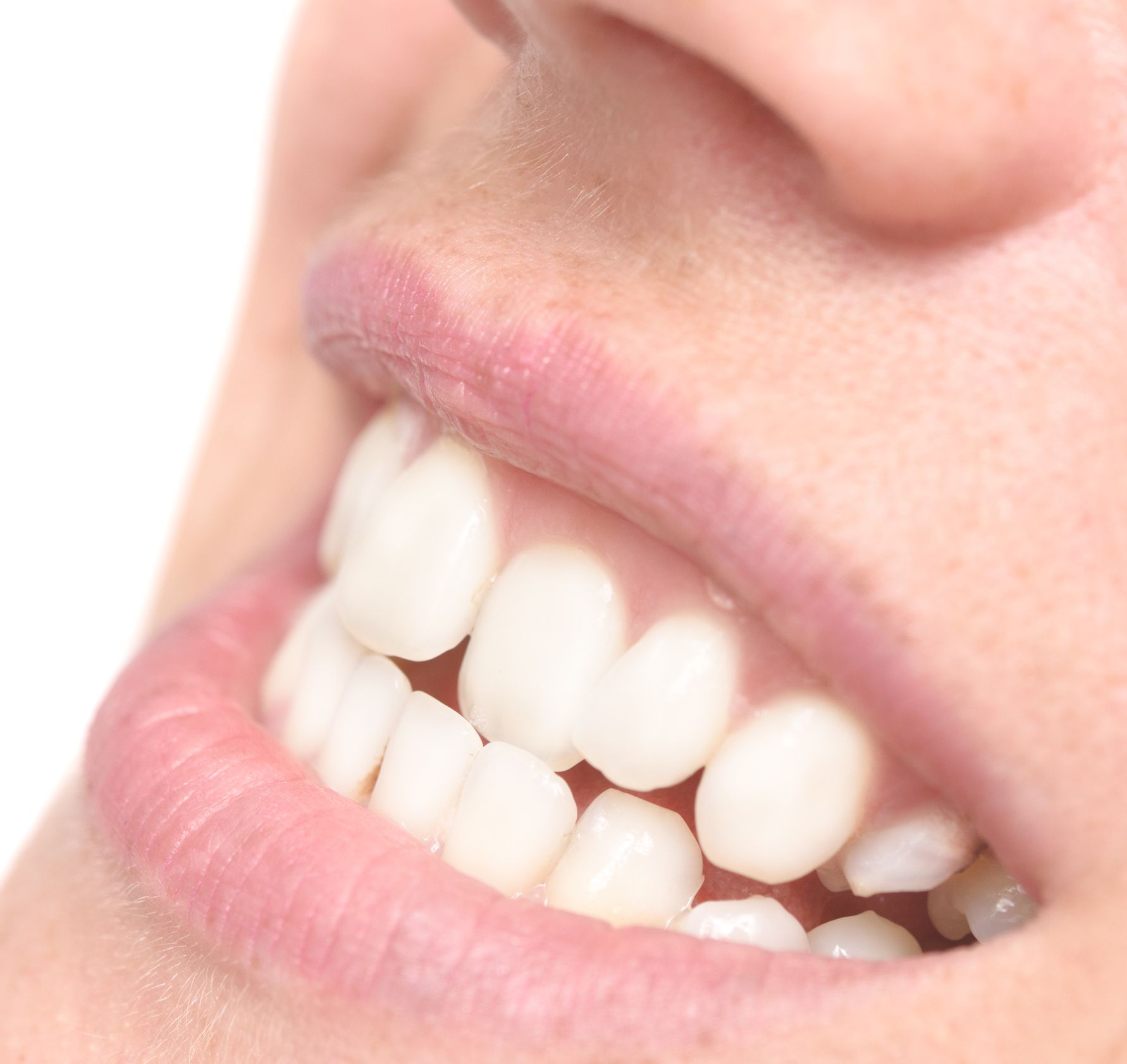 Jutted Tooth Treatments - Memphis, TN Orthodontics and Crooked Teeth