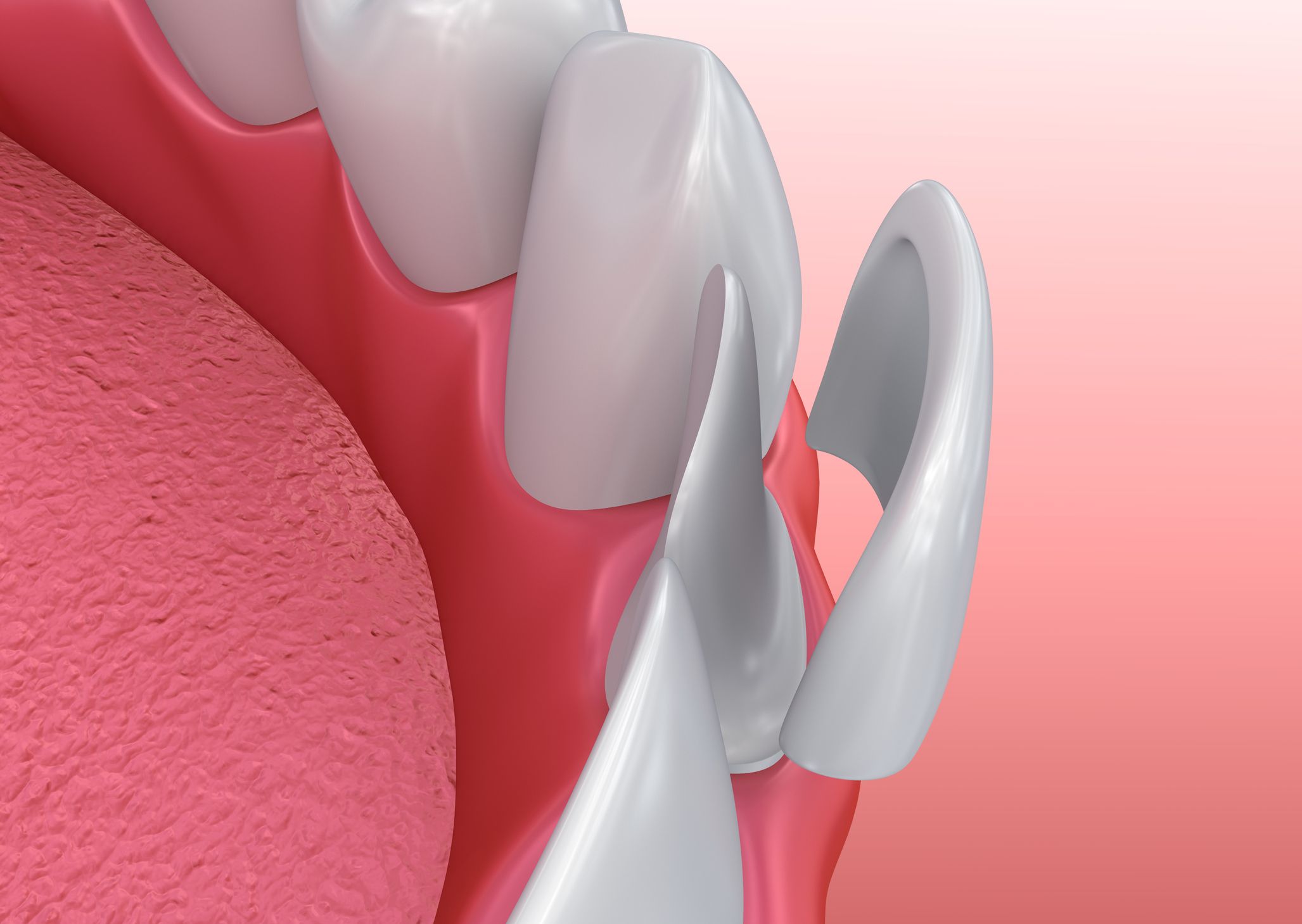 An illustration of the placement of a veneer