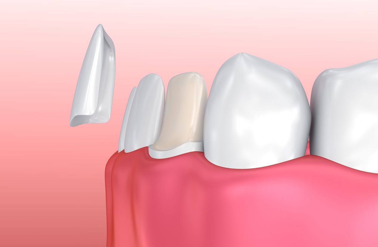 Drawing of the teeth with a porcelain veneer being applied