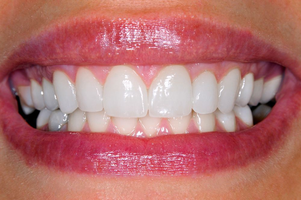 Up close photo of woman’s smile with porcelain veneers