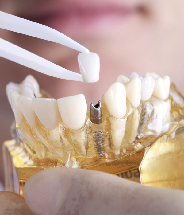 Photo of a dental implant in a mold of a jaw