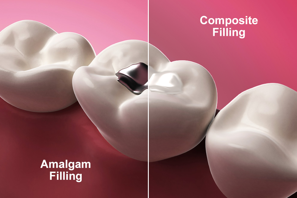 Photo of metal fillings