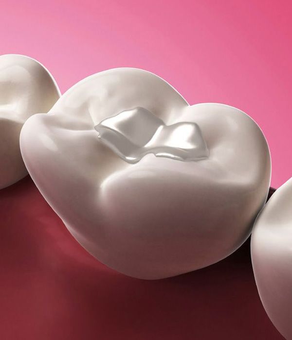 Illustration of tooth-colored filling