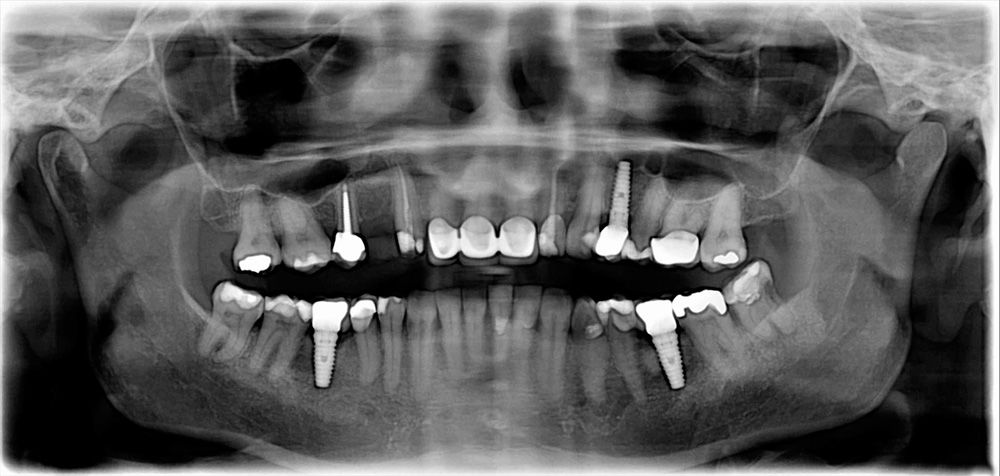 graphic dental x-ray of patient with dental implants