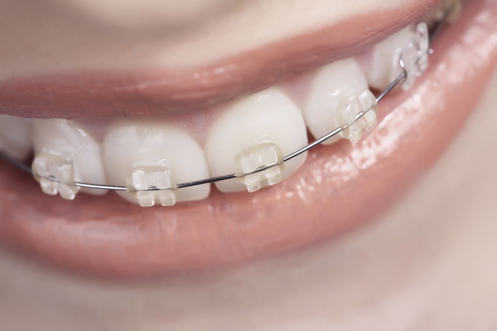 Orthodontic treatment options