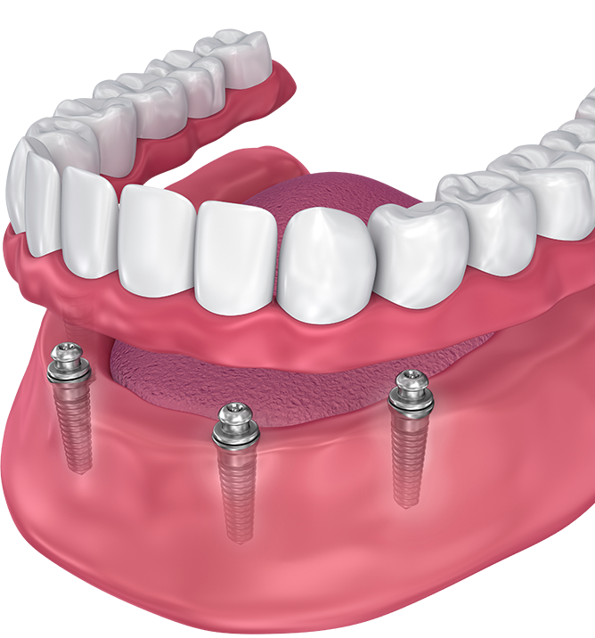 denture implants near me