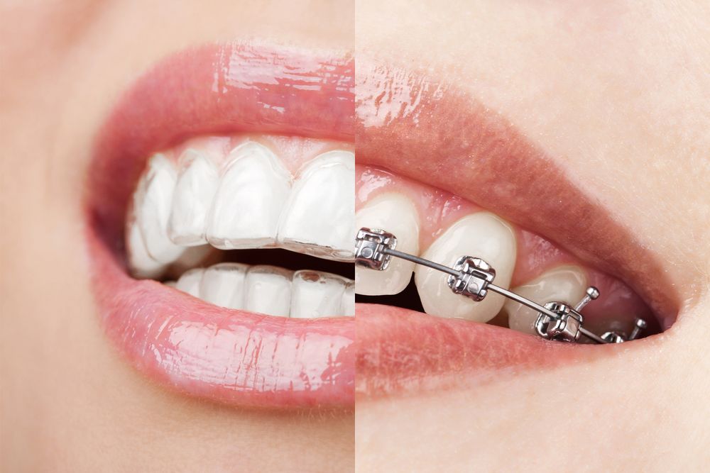side-by-side comparison of Invisalign and braces