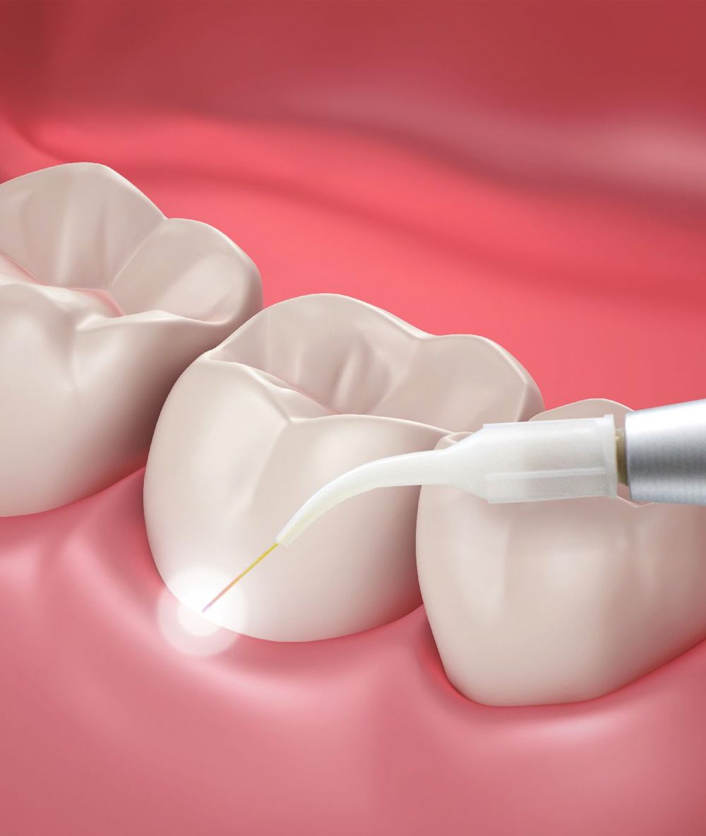 An illustration of a dental cleaning