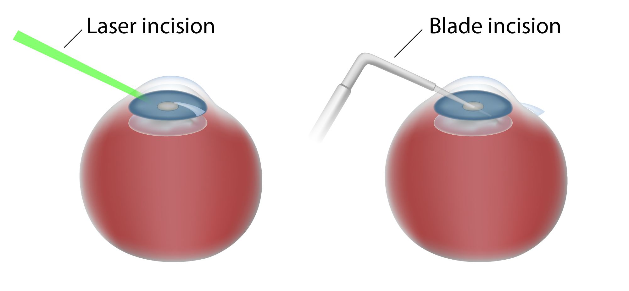 Laser Cataract Surgery Benefits Chicago, IL Wicker