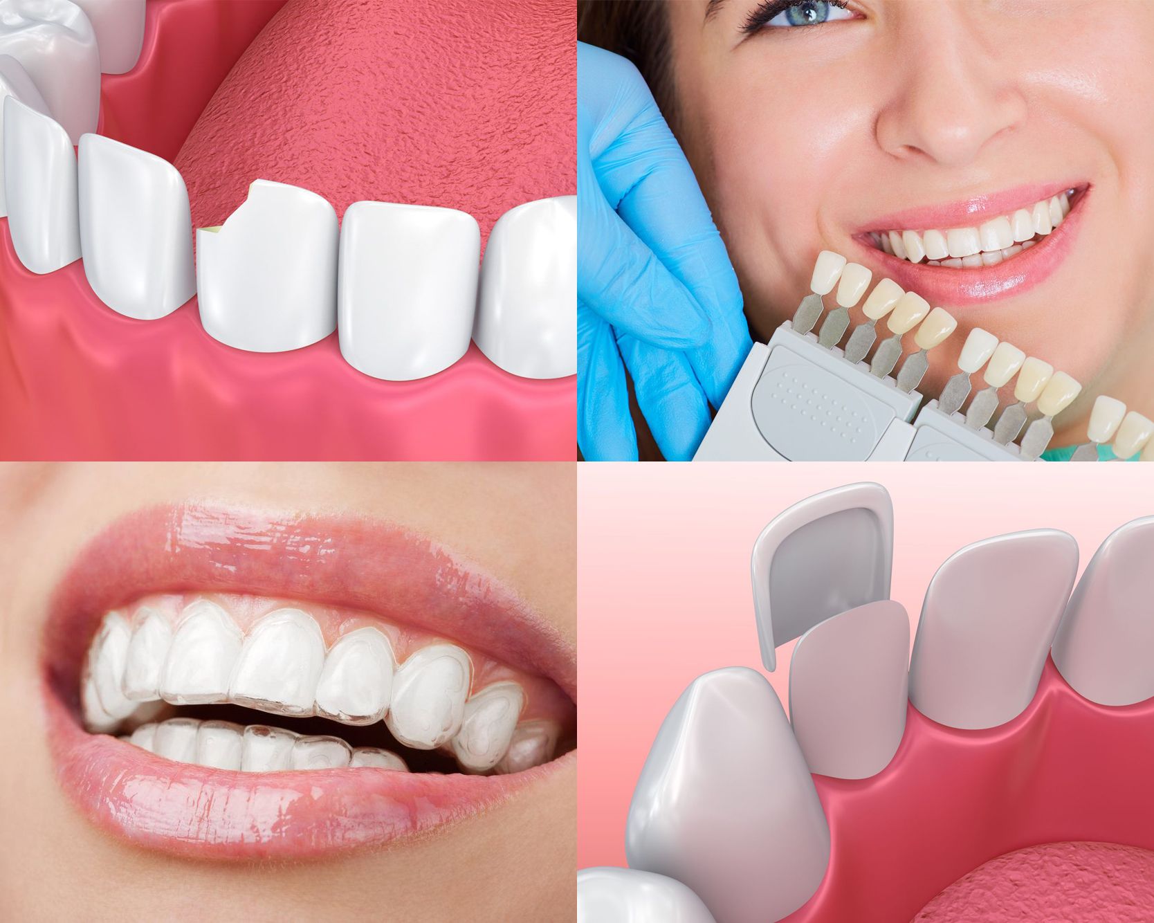 Composite Tooth Bonding Columbia SC