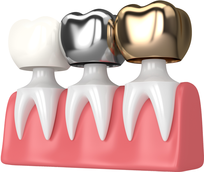 metal crowns