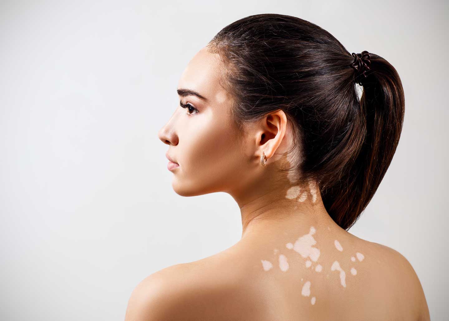 A female patient with Vitiligo.
