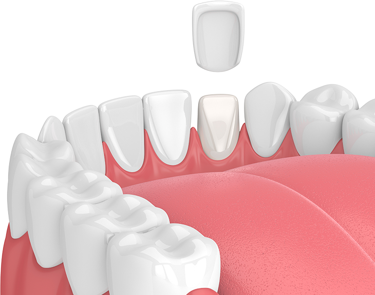 Digital illustration of porcelain veneer placement