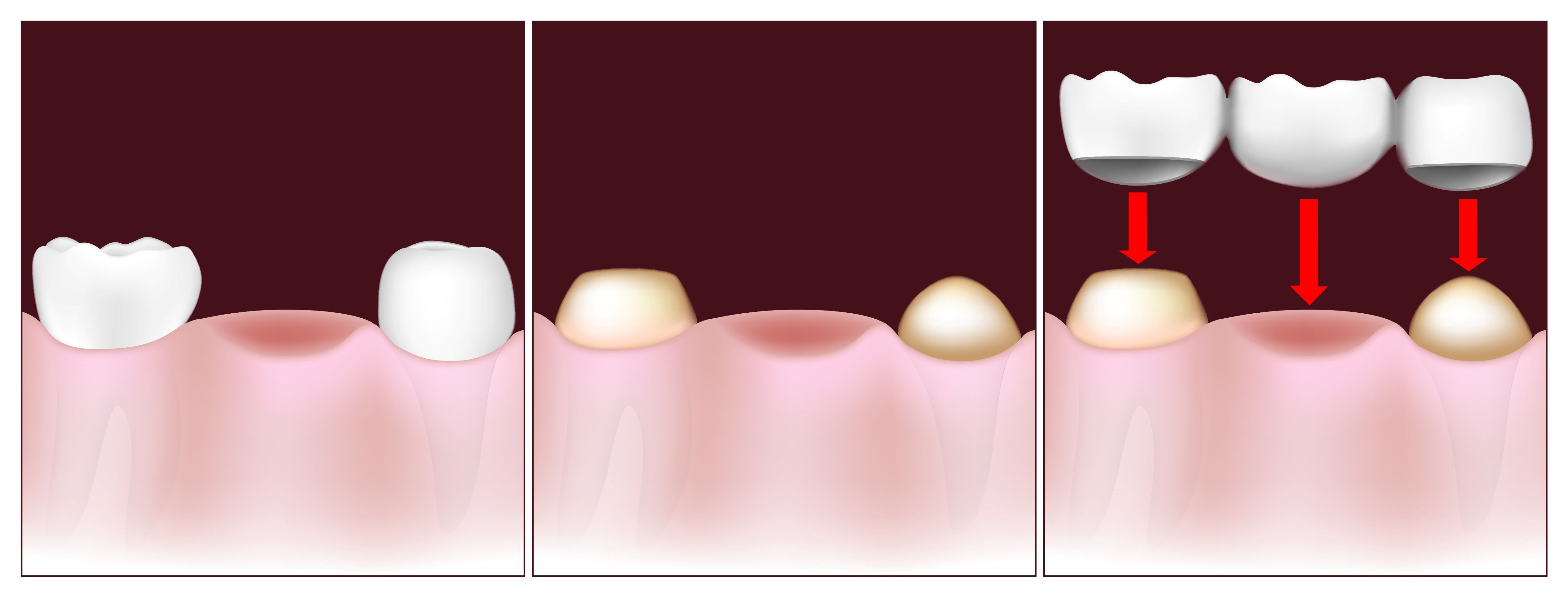 Traditional Dental Bridge Procedure - Harrisonburg, VA