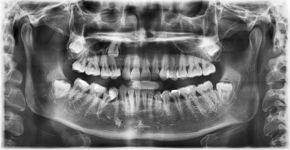 impacted teeth xray