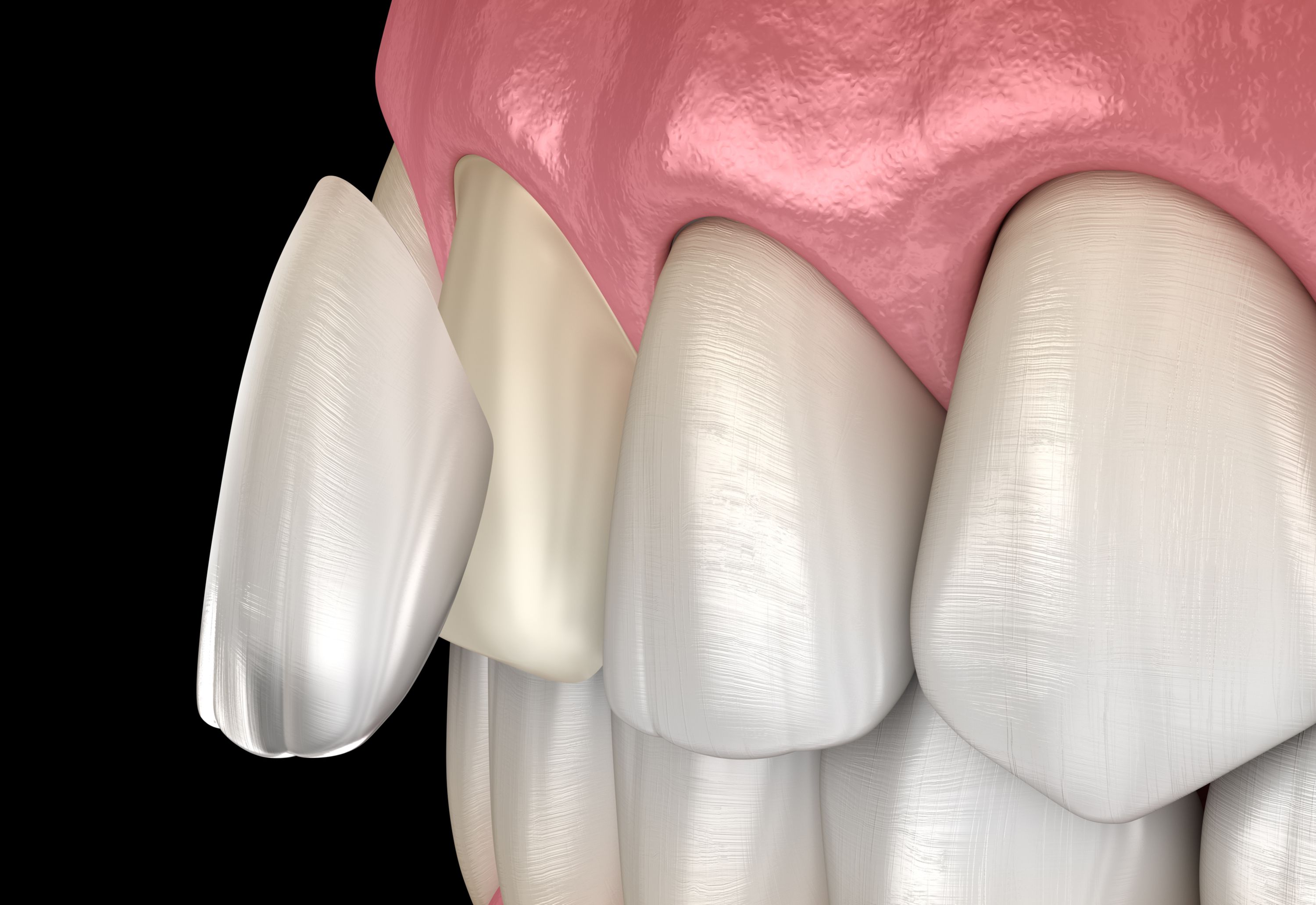 Best Toothpaste For Porcelain Veneers Nashville TN