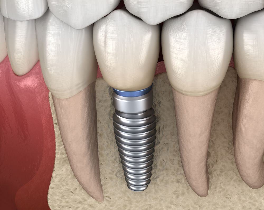 An illustration of an implant-supported crown